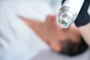 microneedling