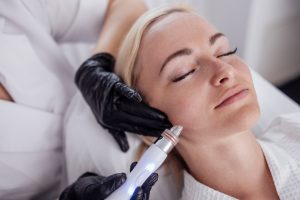 microneedling